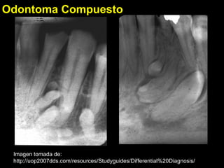 Odontoma