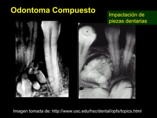 Odontoma