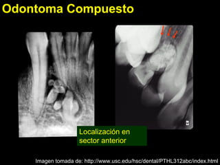 Odontoma