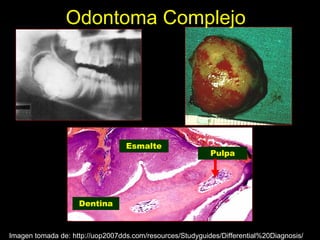 Odontoma