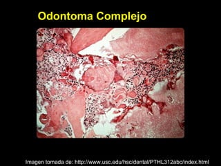 Odontoma