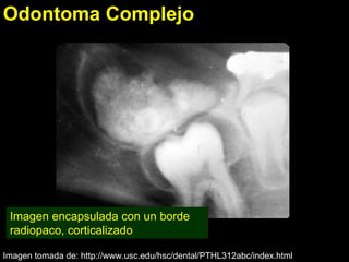 Odontoma