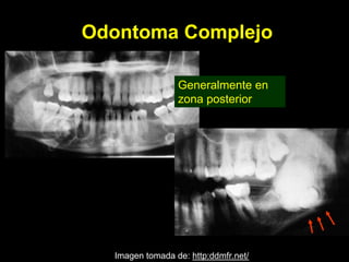 Odontoma