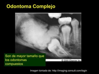 Odontoma