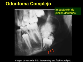 Odontoma