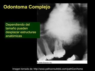 Odontoma