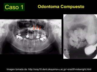 Odontoma