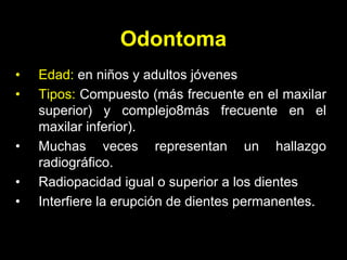 Odontoma