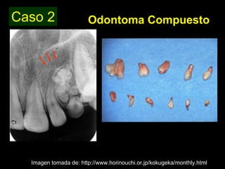 Odontoma