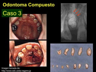 Odontoma