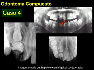 Odontoma