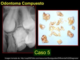 Odontoma