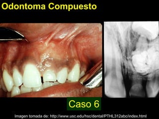 Odontoma