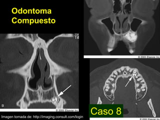 Odontoma