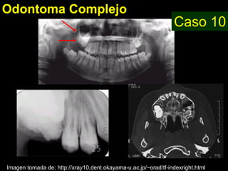 Odontoma