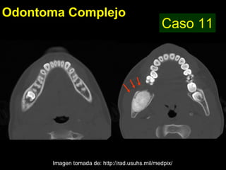 Odontoma