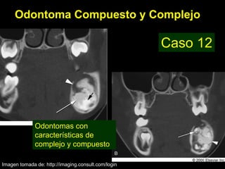 Odontoma