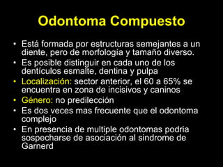Odontoma