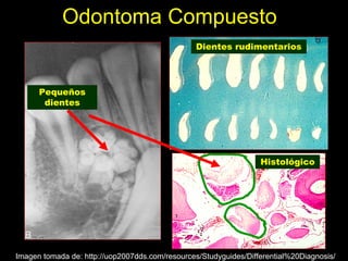 Odontoma