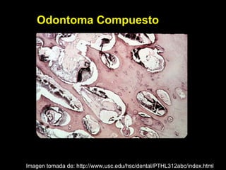Odontoma