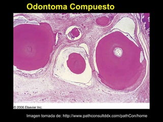 Odontoma