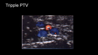 Duplex peripheral veins