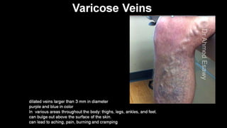 Duplex peripheral veins