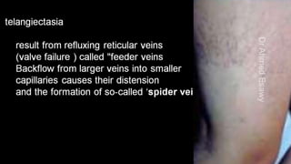 Duplex peripheral veins