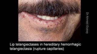 Duplex peripheral veins