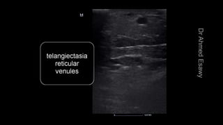 Duplex peripheral veins