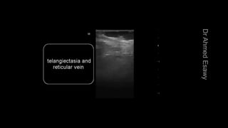 Duplex peripheral veins