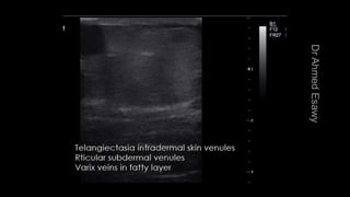 Duplex peripheral veins