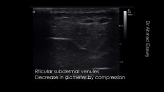 Duplex peripheral veins