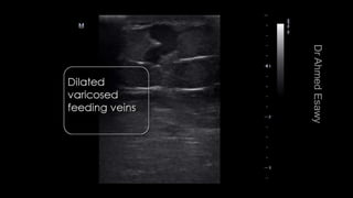Duplex peripheral veins