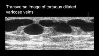 Duplex peripheral veins
