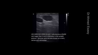 Duplex peripheral veins