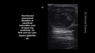 Duplex peripheral veins
