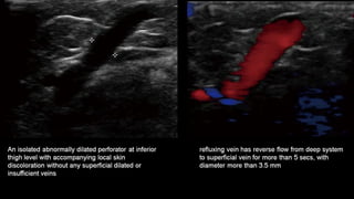 Duplex peripheral veins