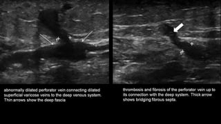 Duplex peripheral veins