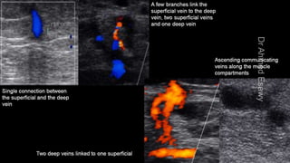 Duplex peripheral veins