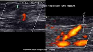 Duplex peripheral veins