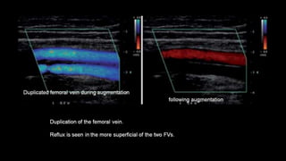 Duplex peripheral veins