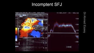 Duplex peripheral veins