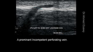 Duplex peripheral veins