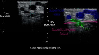 Duplex peripheral veins