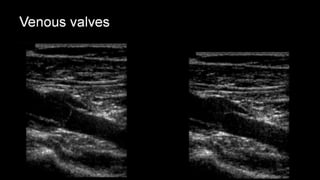 Duplex peripheral veins