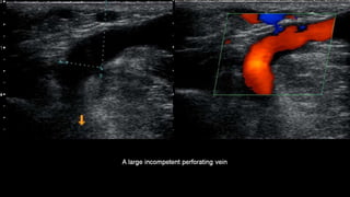Duplex peripheral veins