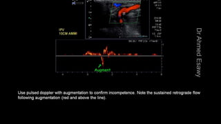 Duplex peripheral veins