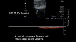 Duplex peripheral veins