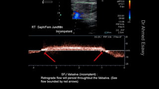 Duplex peripheral veins